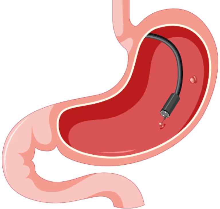 Người có polyp dạ dày cần khám nội soi để kiểm tra và can thiệp loại bỏ nếu cần